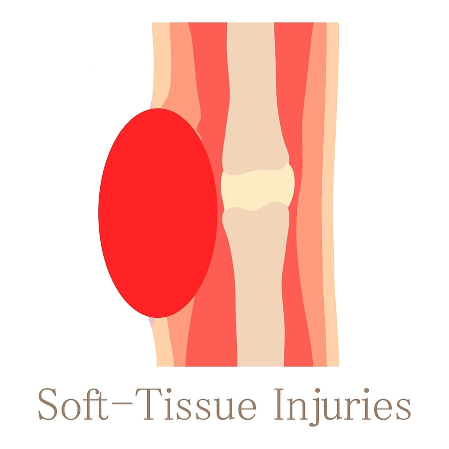 What Is Soft Tissue Injury in an Accident?